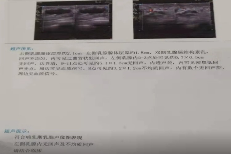 慢性乳腺炎B超报告单图