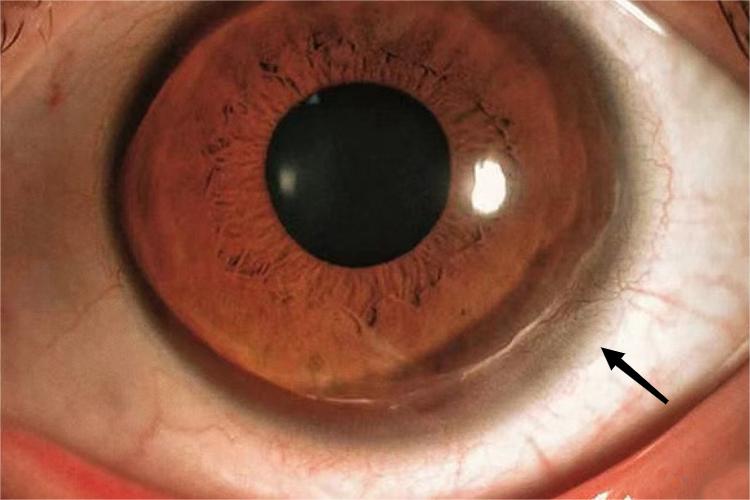 网状及垂帘状新生血管图 网状及垂帘状新生血管图