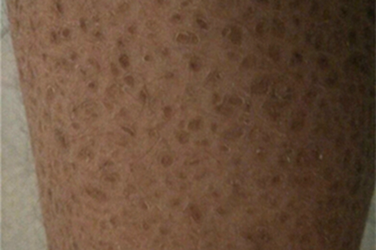 寻常型鱼鳞病小腿皮肤出现黑痂图 寻常型鱼鳞病小腿皮肤出现黑痂图