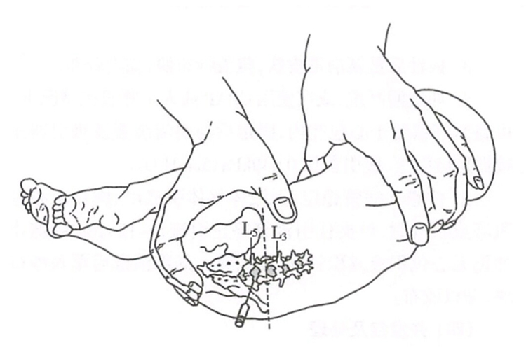 新生儿腰椎穿刺部位图