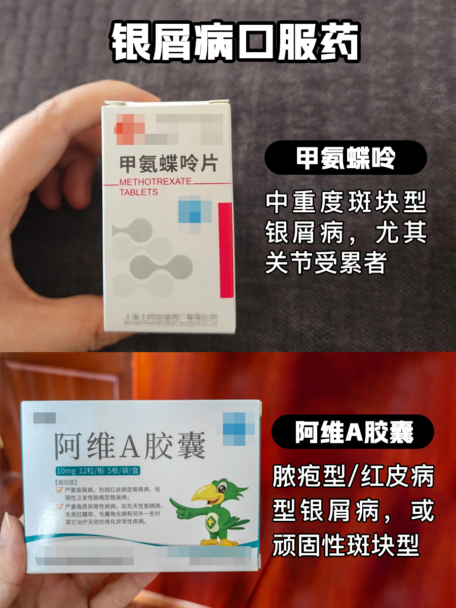 银屑病口服药-医生手把手教你对抗银屑病！