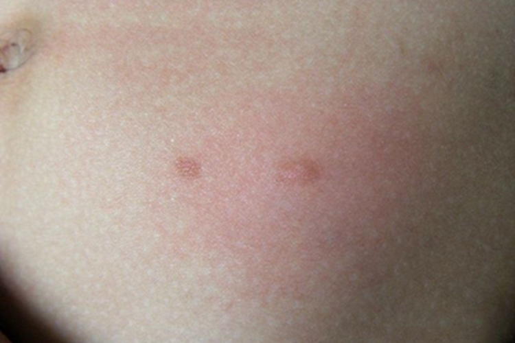 色素性荨麻疹症状图