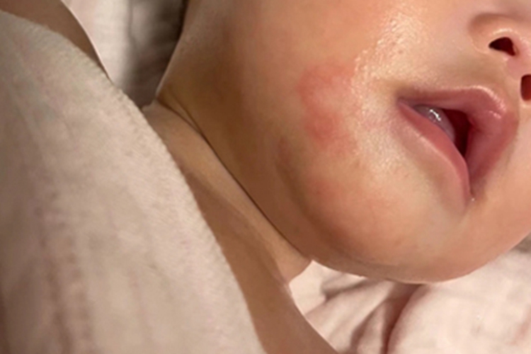 婴儿期特应性皮炎下巴小疙瘩图
