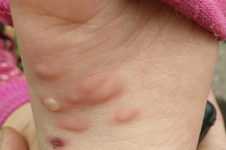 水痘脚底长了几个水疱图