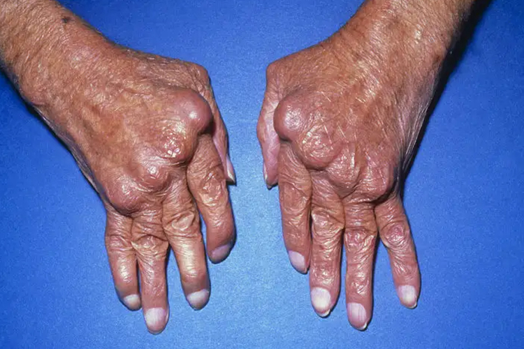 风湿性关节炎图