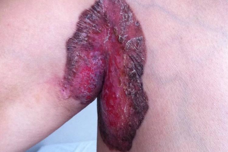 腋窝湿疹样癌图