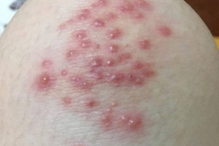 铜绿假单胞菌毛囊炎水疱图