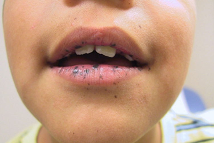 色素沉着息肉综合征嘴唇黑斑图
