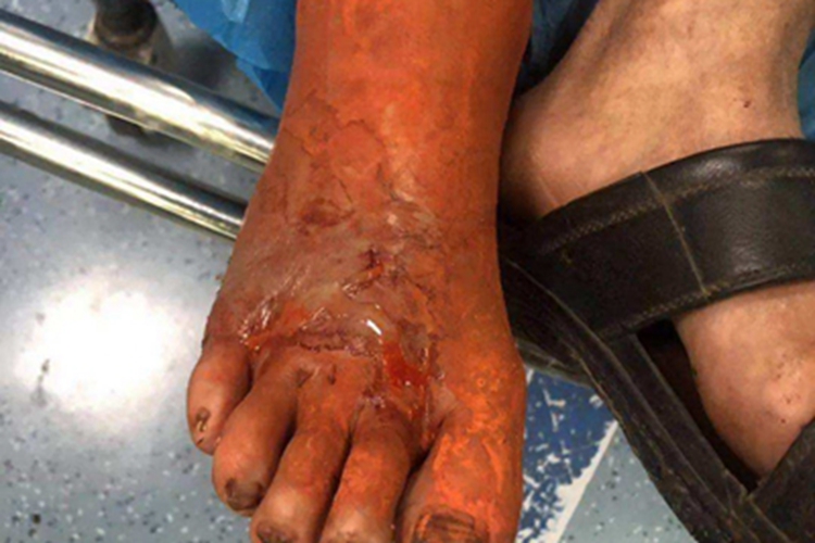 蛇咬伤脚背肿胀水疱图