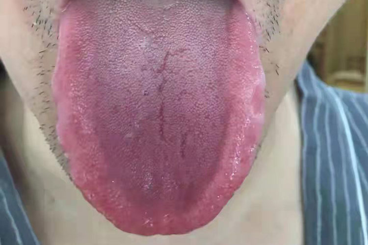 脾气虚证的舌象图