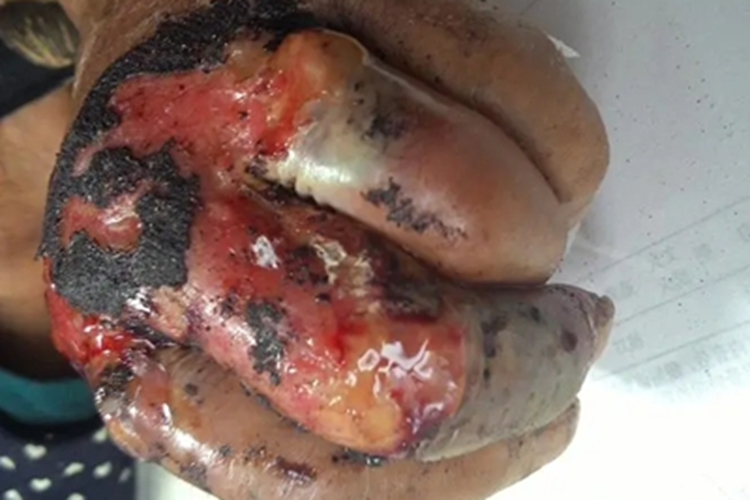 大疱型坏疽性脓皮病手指溃疡图