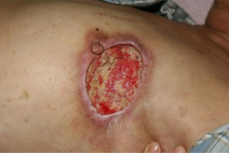 男性乳腺癌乳房症状图