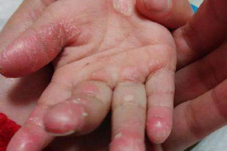 小孩鳞屑角化型手癣图