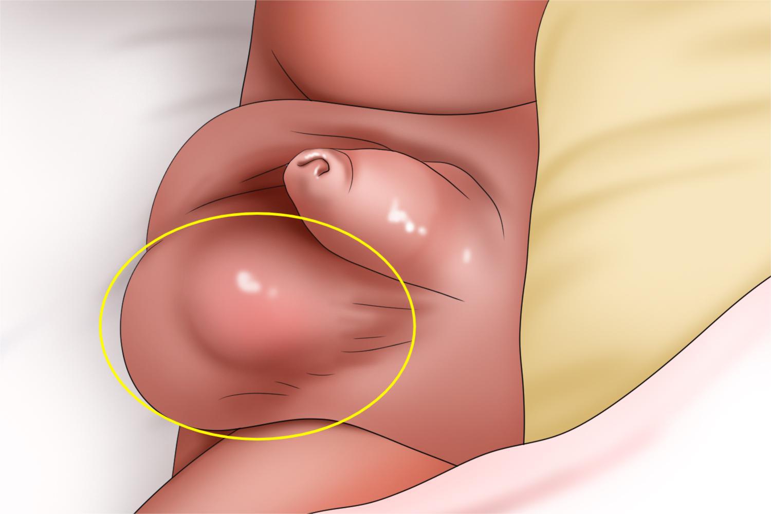睾丸鞘膜积液阴囊症状手绘图