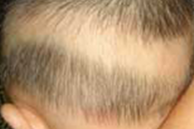 佝偻病宝宝枕秃图