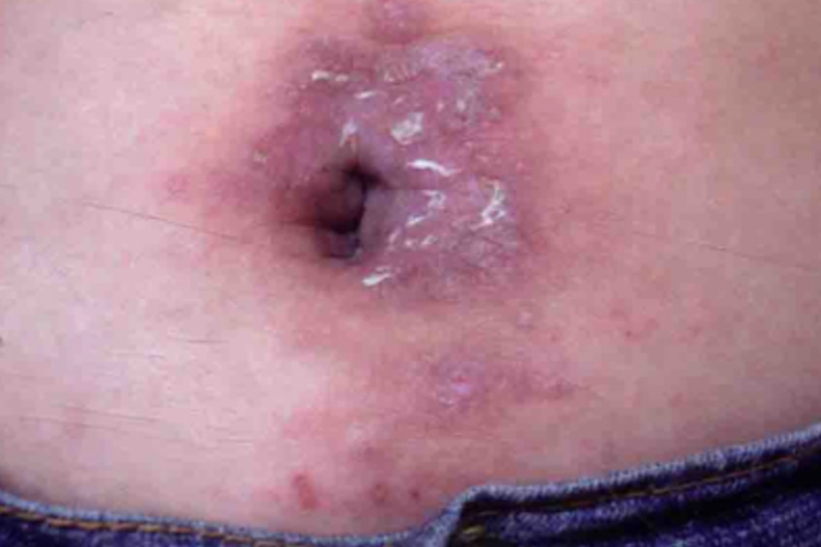 接触性皮炎肚脐红疹图