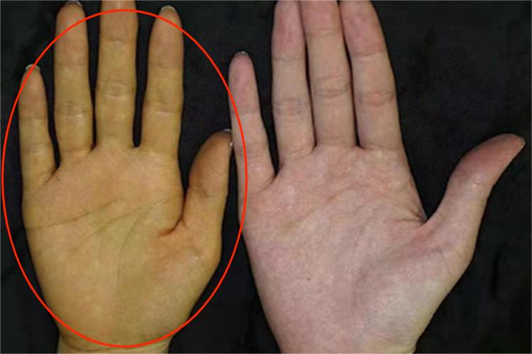 胡萝卜素血症手部症状图 胡萝卜素血症手部症状图