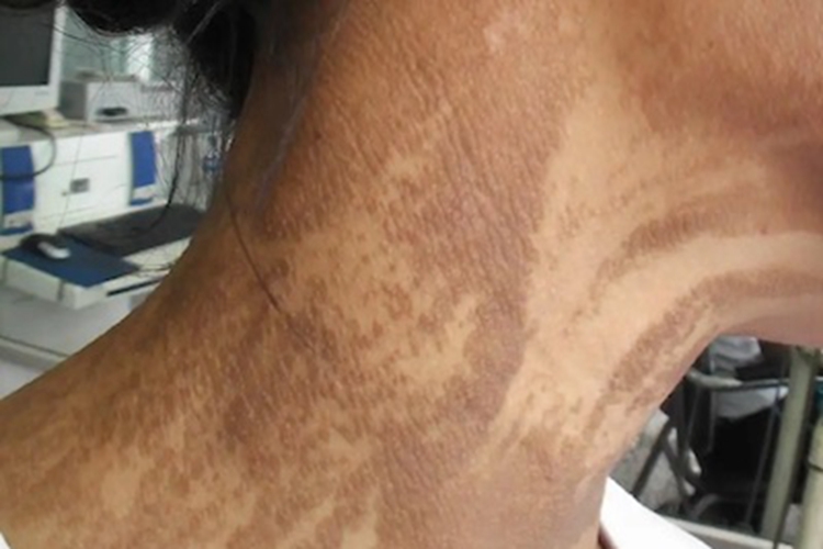 泛发型表皮痣症状图