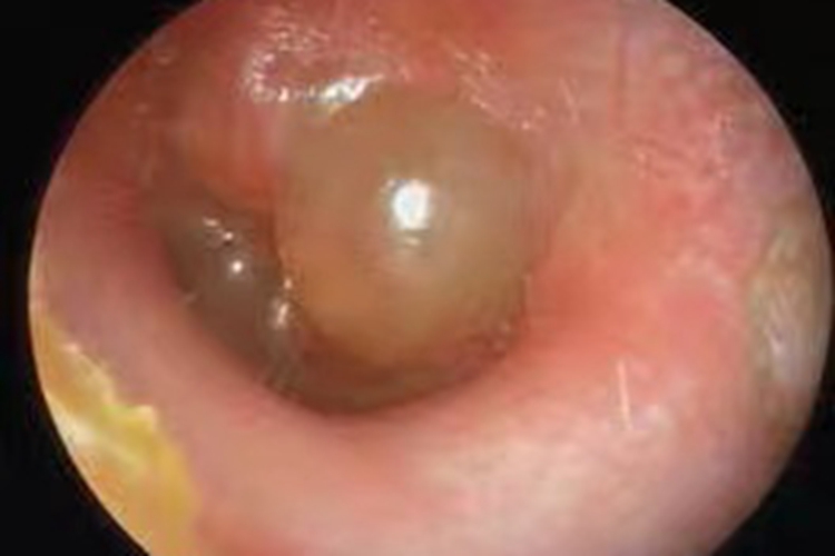 大疱性鼓膜炎耳镜检查图