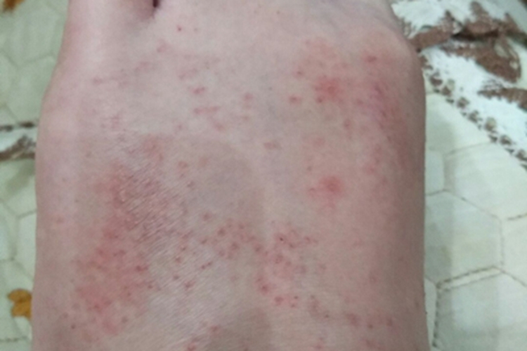 儿童丘疹性肢端皮炎脚背症状图