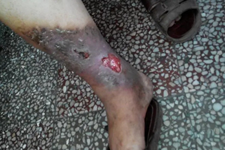 抗磷脂综合征小腿症状图 抗磷脂综合征小腿症状图