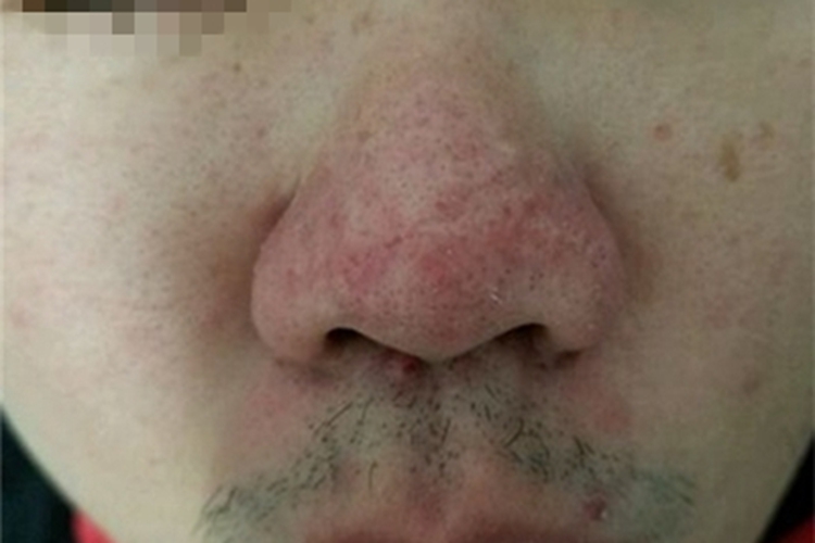 丘疹脓疱型酒糟鼻鼻尖皮肤粗糙图