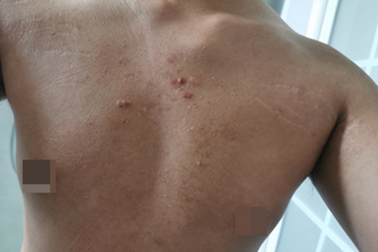 毛囊炎胸部症状图 毛囊炎胸部症状图