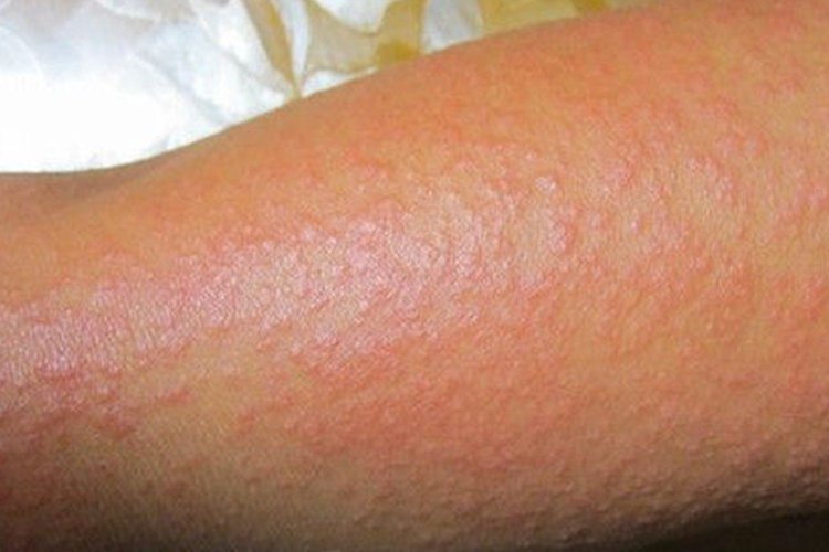 多形性日光疹手臂紫外线过敏图