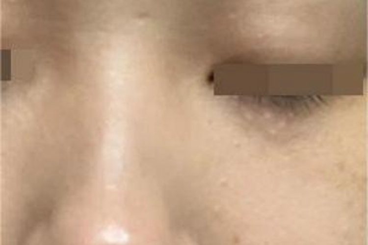 汗管瘤眼周有小丘疹图 汗管瘤眼周有小丘疹图