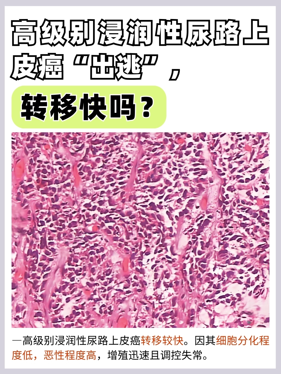 高级别浸润性尿路上皮癌“出逃”，转移快吗？