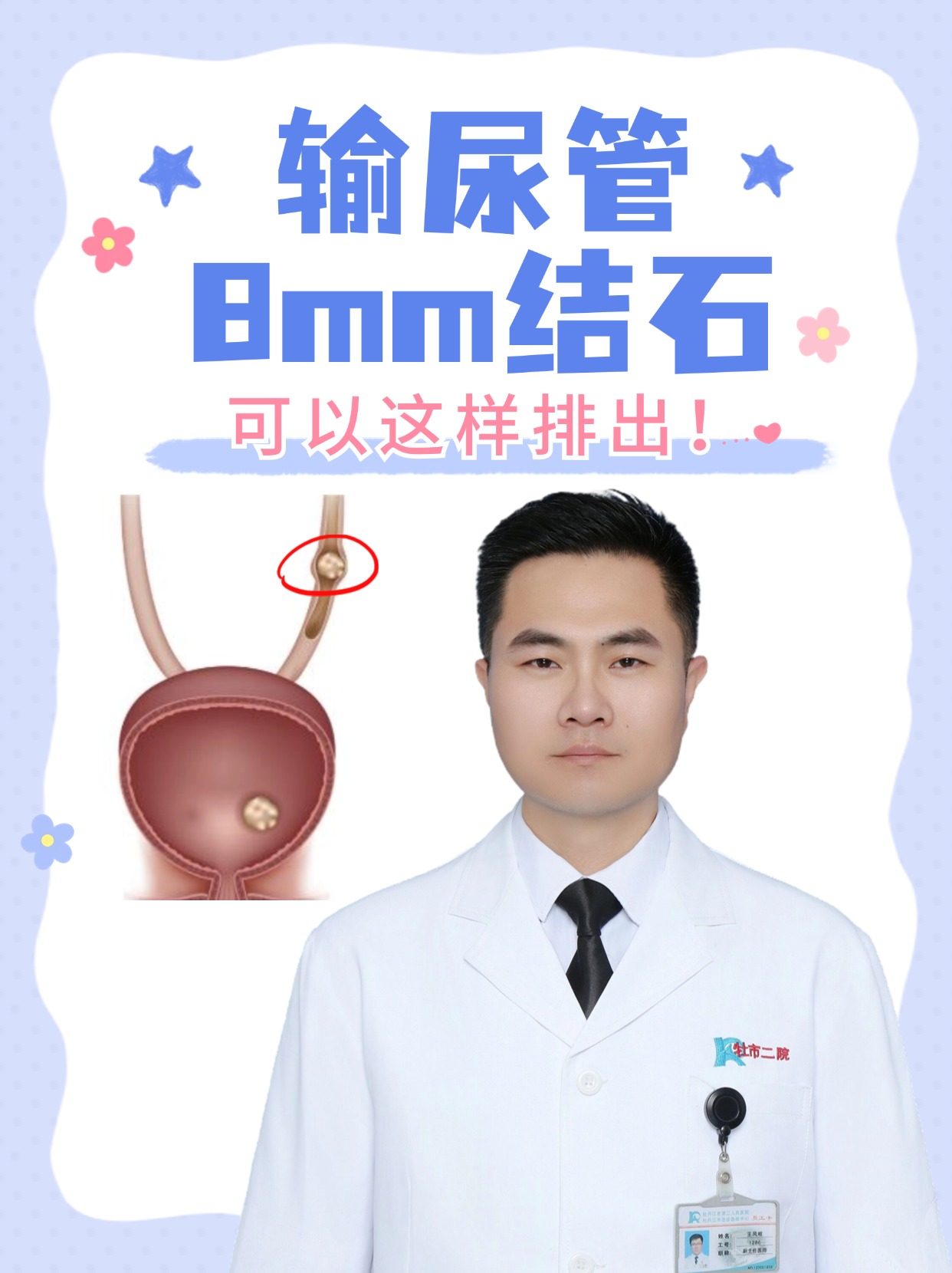 输尿管8mm结石,可以这样排出!