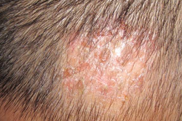 C5功能不全综合征头皮结痂图 C5功能不全综合征头皮结痂图