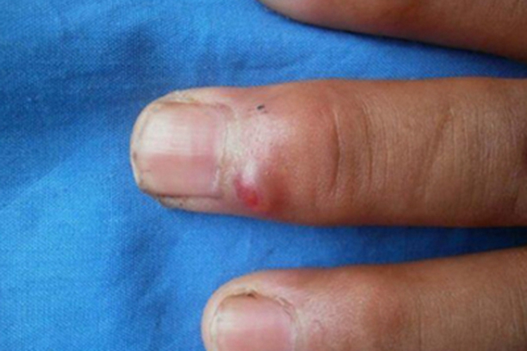 黏液样囊肿症状图