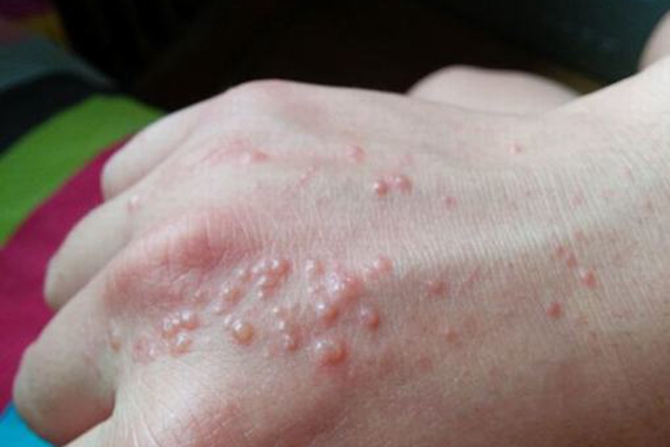 急性湿疹图