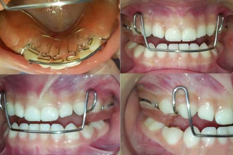 门牙内凹直接佩戴矫治器过程图