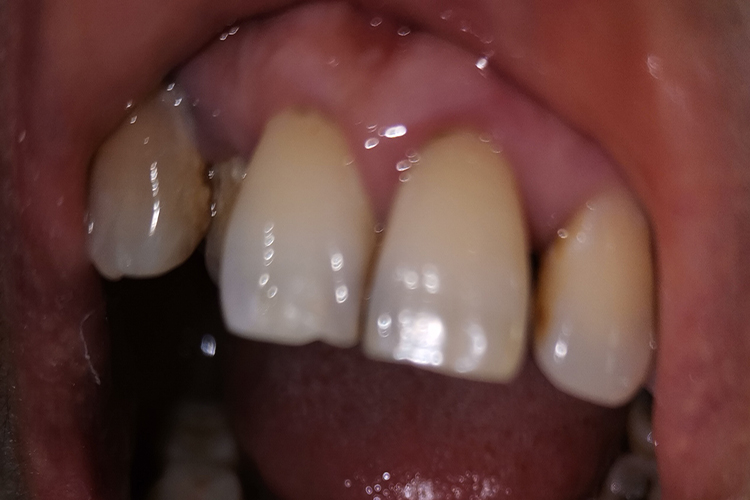 牙龈萎缩早期红肿图