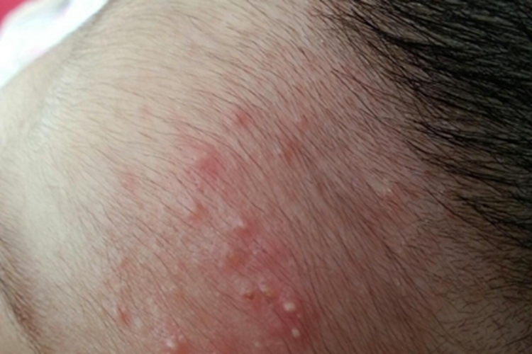 急性湿疹前额红疹冒白尖图