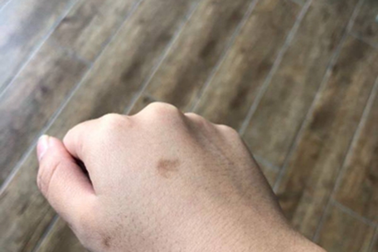 色素性紫癜性皮疹手背斑图