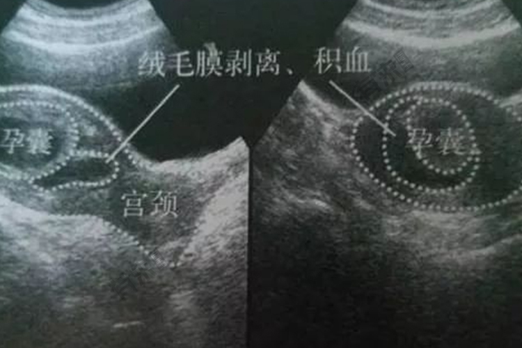 先兆流产超声图