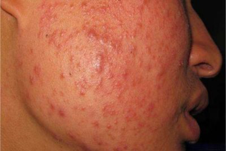 颜面粟粒性狼疮面部症状图 颜面粟粒性狼疮面部症状图