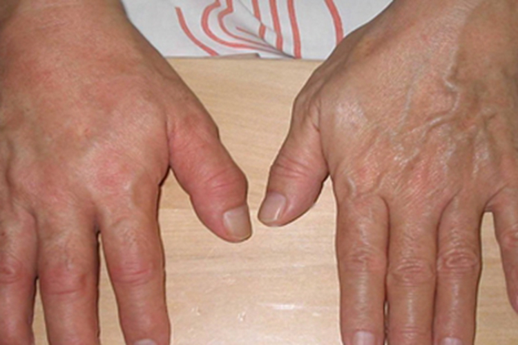 肩手综合征疼痛期手部肌肉萎缩图