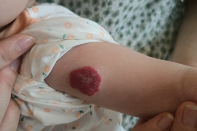 浅表型婴儿血管瘤胳膊红斑图