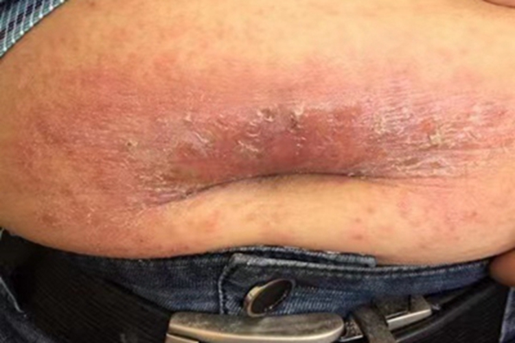 刺激性接触性皮炎腹部结痂图