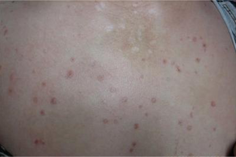 汗孔角化症前胸长褐色凸起的斑图