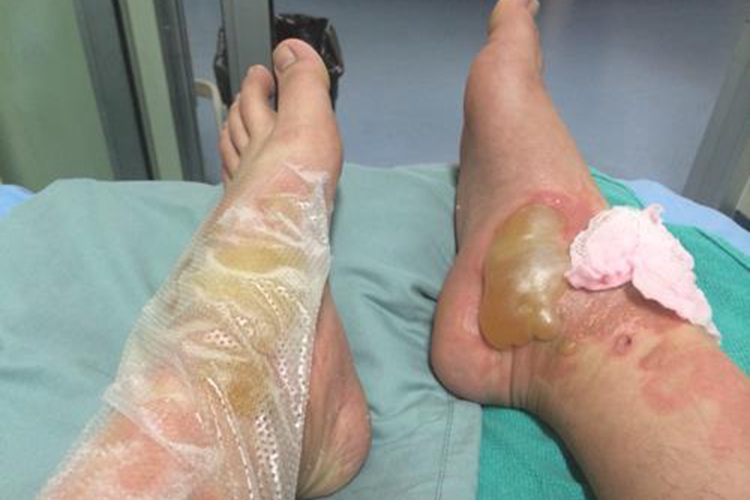 浅Ⅱ度烧伤水疱图 浅Ⅱ度烧伤水疱图