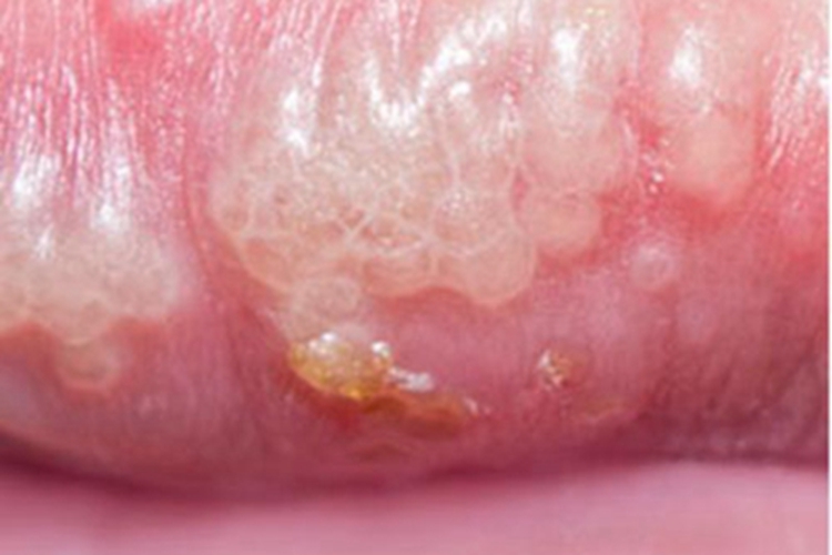 艾滋病嘴唇水疱图