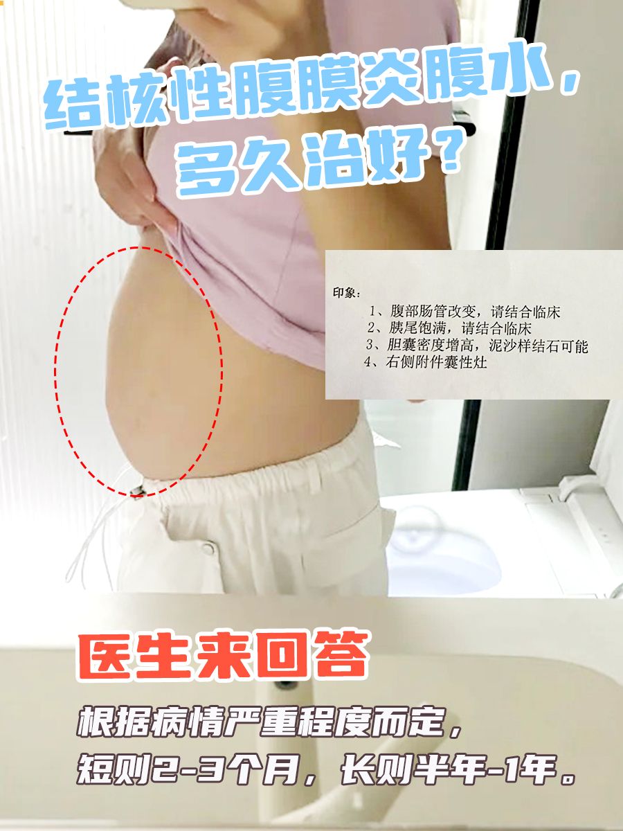 结核性腹膜炎腹水多久治好？医生来回答