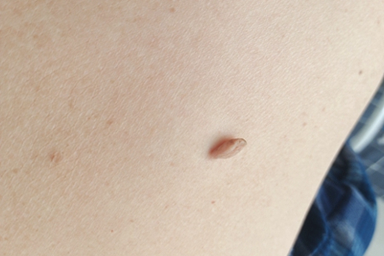 皮肤纤维瘤肉粒图