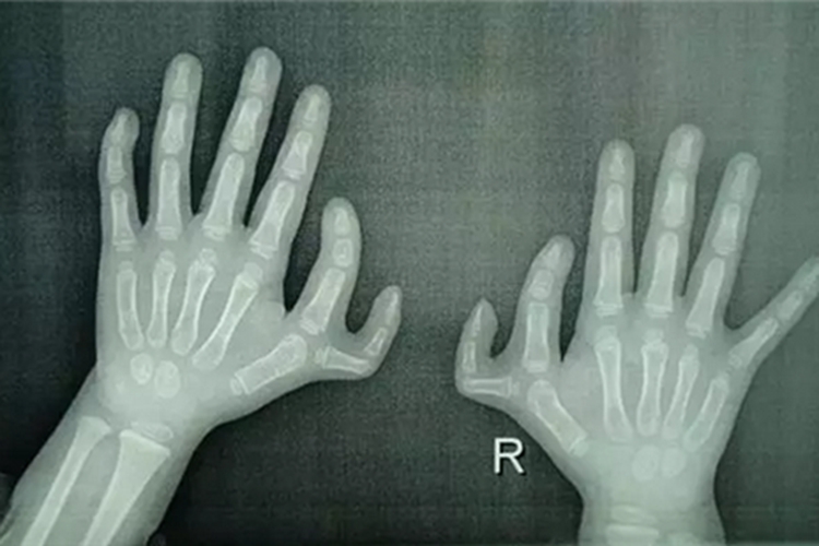 多指畸形X线检查图