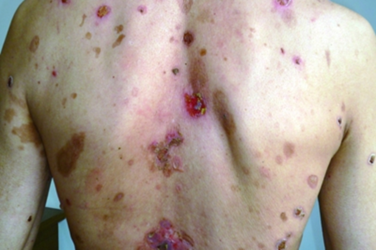 落叶型天疱疮背部红斑图 落叶型天疱疮背部红斑图